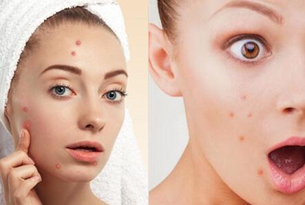 南寧美容學校：祛除痘痘的美容方法