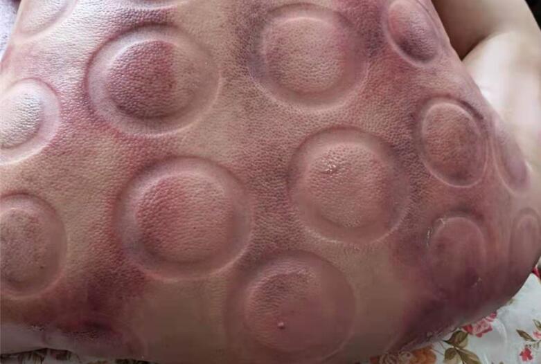 怎樣拔火罐？南寧美容學(xué)校手把手教你