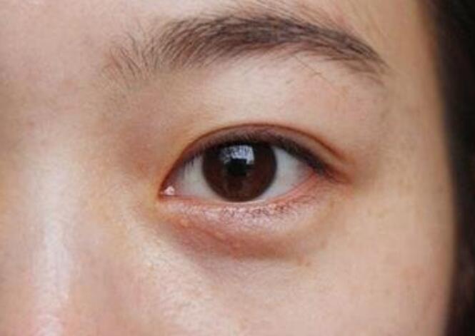 黑眼圈的種類有哪些？廣西美容培訓教你保養(yǎng)