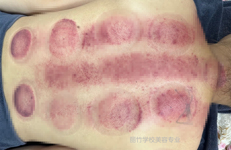 拔火罐的顏色代表什么？南寧美容美體專業(yè)實訓(xùn)