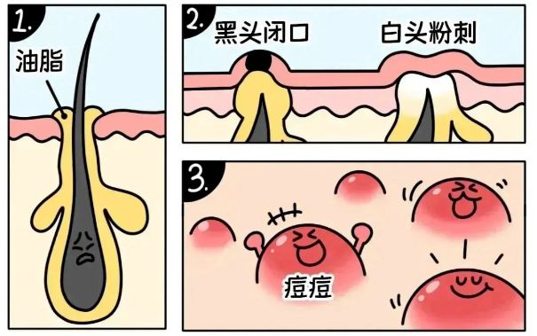 不同部位閉口形成的原因，南寧美容護(hù)膚學(xué)校解答