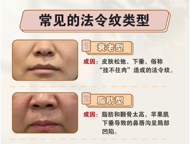 你的法令紋路是怎么產(chǎn)生的 | 美容護膚小知識